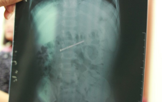 Giải cứu bé trai 18 tháng tuổi nuốt đinh dài 4,5cm