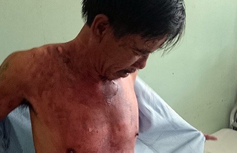 Chồng phải nhập viện vì ra tay đánh vợ