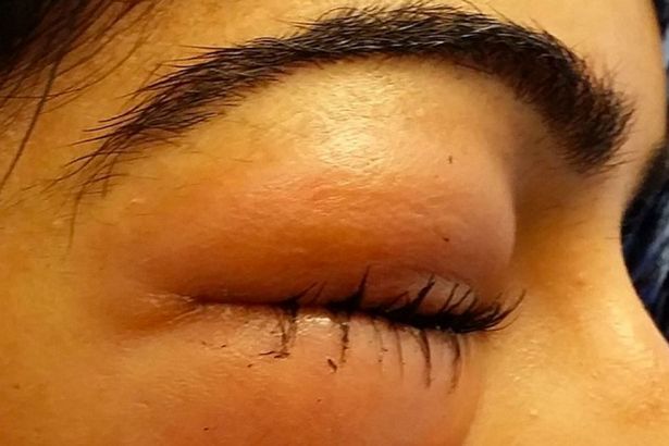 Hy hữu: Suýt bị mù chỉ vì một cú xì mũi