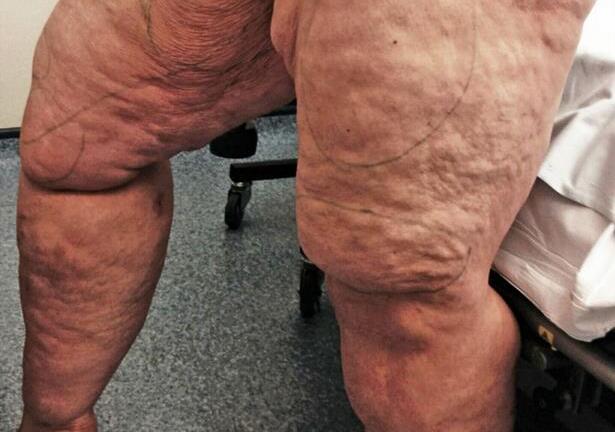 Ngỡ ngàng ngắm cô gái từ đôi chân voi thành chân dài thon đẹp