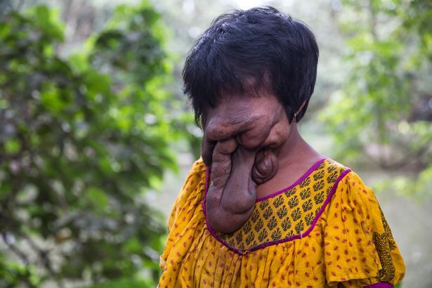 Gặp cô gái 21 tuổi không có mặt vì mắc bệnh hiếm gặp