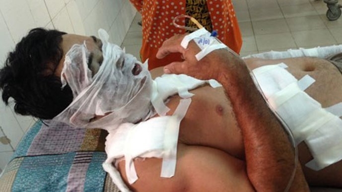 Nửa đêm vợ tìm đến chồng cũ… tạt axít