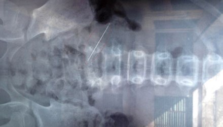 Cứu sống bé gái bị kim đâm xuyên bụng