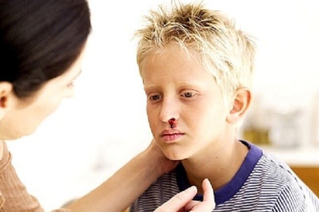 Chảy máu cam và những tác hại khôn lường