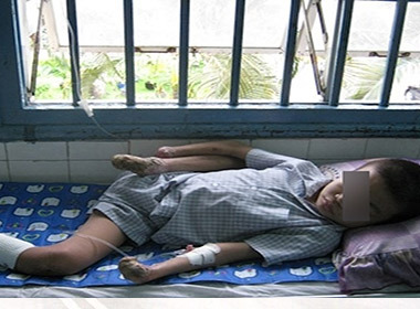 TP.HCM: Mắc bệnh rụng tay chân, thanh niên 18 như đứa trẻ 10 tuổi