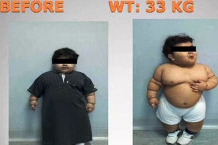 Bé 2 tuổi phẫu thuật dạ dày để... giảm béo