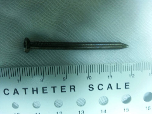 Cứu sống bé 2 tuổi nuốt gọn đinh sắt dài 5cm vào bụng 