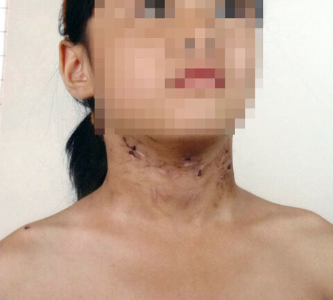 Bắt tạm giam, khởi tố kẻ đánh gãy xương con gái ruột 6 tuổi