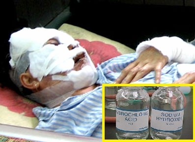 Chồng thuê người tạt axit vợ vì ghen tuông