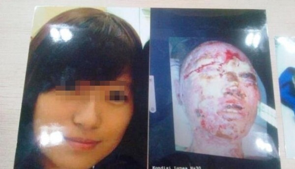 Kinh hoàng nữ sinh bị người yêu cũ tạt axit tàn phá hết khuôn mặt
