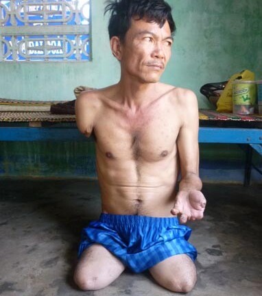 Người đàn ông chân tay bị khô héo rồi rụng dần ở Khánh Hòa