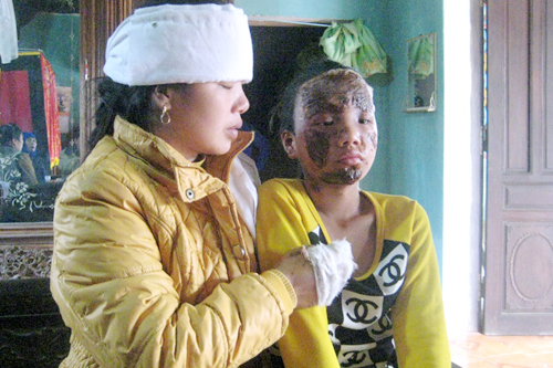 Vụ nổ quà sinh nhật: Mặt bé gái bị cháy xém