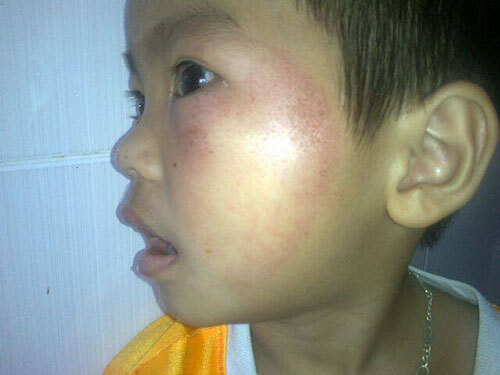 Mẹ hiệu trưởng mầm non đánh bầm giập bé 4 tuổi?