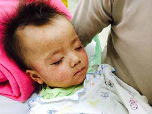 Thủ tướng quyết định bổ sung tiền, máy thở để chống dịch sởi