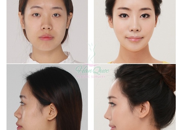 Thẩm mỹ khuôn mặt đẹp toàn diện tại Thẩm mỹ JW