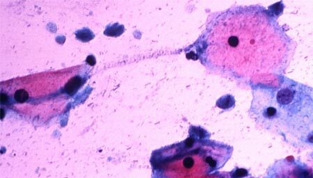 Ung thư tuyến tiền liệt có thể là bệnh tình dục