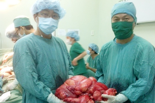 Lấy khối u nặng 11kg ra khỏi ổ bụng bệnh nhân