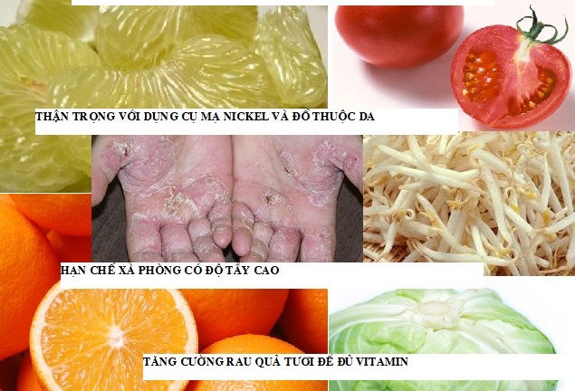 Bệnh á sừng: Làm gì để hạn chế khó chịu?