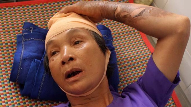 Cụ bà 67 tuổi bị bỏng nặng vì điện thoại cố định phát điện