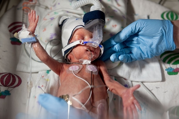 Nghị lực sống của em bé sinh thiếu tháng