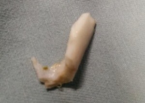 Bé trai một tuổi bị hóc xương lợn