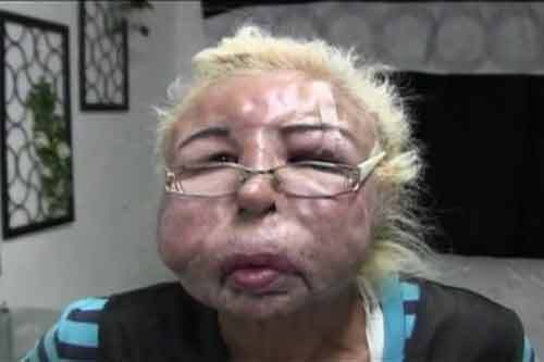 Mặt biến dạng khủng khiếp vì tự làm đẹp ở nhà