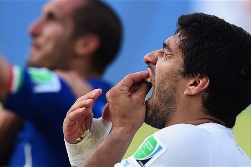 Suarez không cắn người, lỗi ở… hàm răng vẩu?