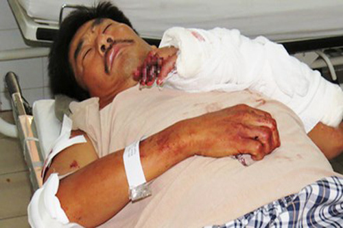 Trạm trưởng bảo vệ rừng bị chém gần lìa bàn tay