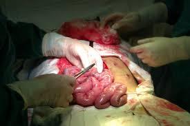 Ruột thủng 4 lỗ chỉ khâu 3, bệnh nhân tử vong