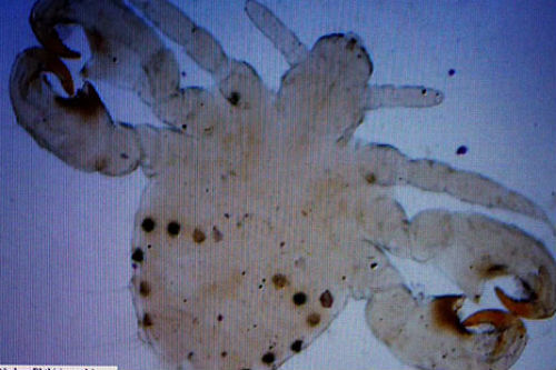 Hoang mang dịch rận mu ký sinh vùng kín tái xuất