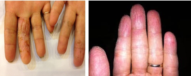  Hỏi đáp về bệnh á sừng 