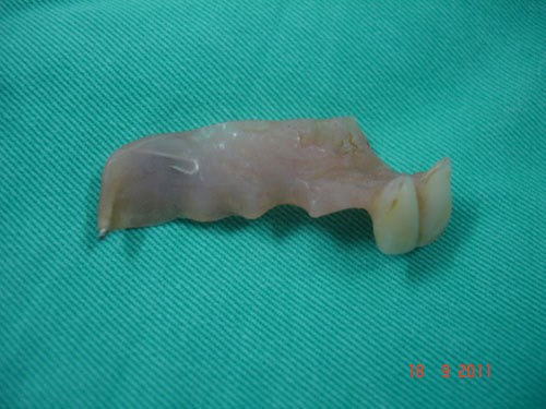 Ruột bị hoại tử vì... 2 cái răng giả