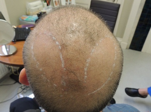 Dùng lông ngực cấy tóc cho nam giới bị hói