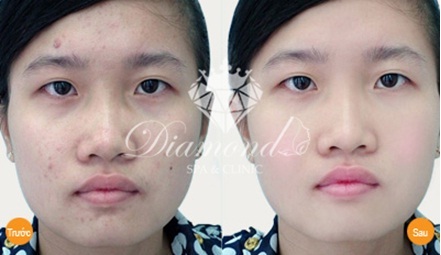 Cam kết trị mụn hiệu quả cho cả Nam và Nữ giảm giá 70\%