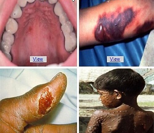 Tin tức bệnh Ebola mới nhất:Những điều cần biết về thuốc đặc trị