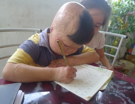 Cuộc sống của cháu bé bị cha đốt 3 năm trước