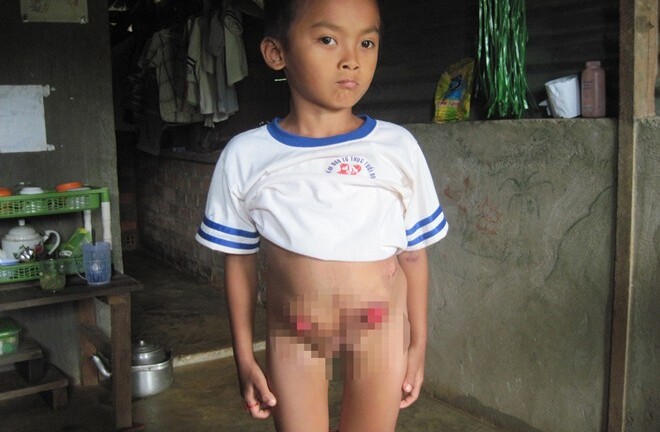 Bé trai nhầm giới tính vì không có hậu môn, bộ phận sinh dục