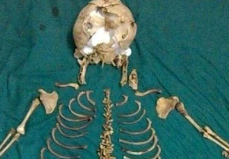 Chuyện lạ: Bào thai nằm suốt 36 năm trong bụng mẹ