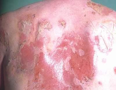 Vẩy nến toàn thân và cách điều trị