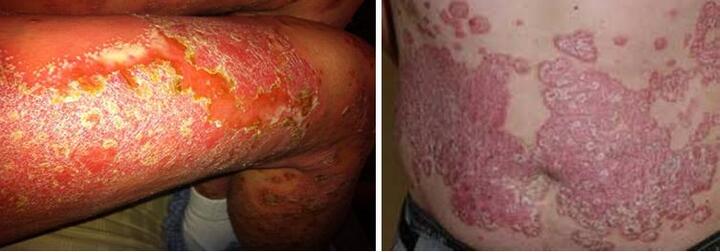 Giải Pháp Hiệu Quả Đặc Trị Bệnh Vảy Nến