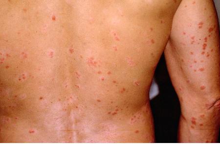 Vẩy nến có lây không?