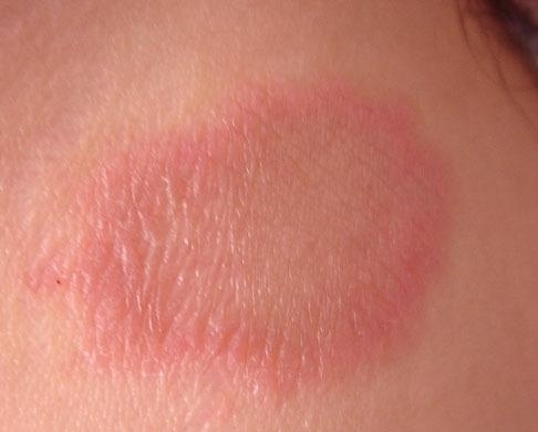 Điều trị bệnh vẩy phấn hồng