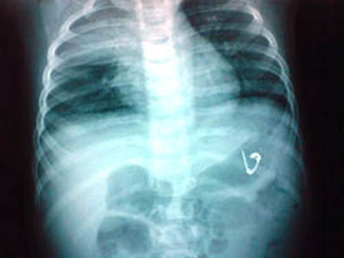 Bé 2 tuổi nuốt kim băng khi mẹ mải làm việc nhà