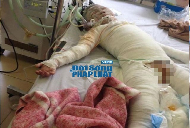 Dùng xăng tẩy nhựa đường, cả gia đình bị bỏng nặng