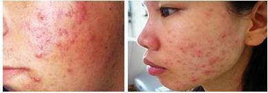 Trị mụn ở Bảo Thanh Đường