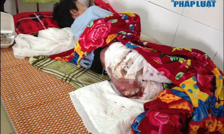 Làm rõ vụ bé trai bỏng nặng do nghi bị mẹ đẩy vào đống lửa