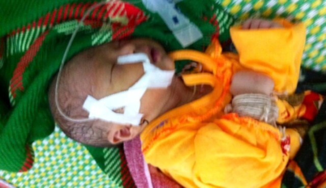 Bé 22 tháng nguy kịch vì đạp phải mảnh sành