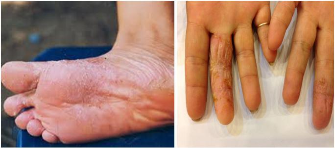 Chữa bệnh á sừng, tổ đỉa ở Bảo Thanh Đường