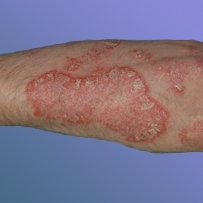 Hỏi và đáp về bệnh vẩy nến