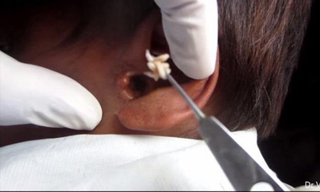 Clip: Khủng khiếp cảnh gắp hàng trăm con giòi khỏi tai người